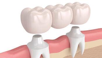 Stronger, Healthier Teeth: The Lasting Benefits of Dental Crowns