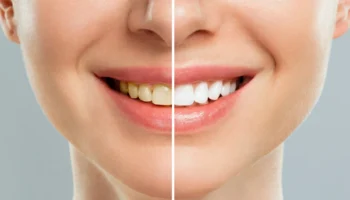 Whiter Teeth, Brighter You: The Complete Guide to Teeth Whitening